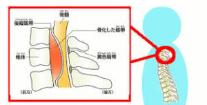 後縦靭帯骨化症について 大阪で訪問マッサージは堺市のはぎわら鍼灸マッサージ院